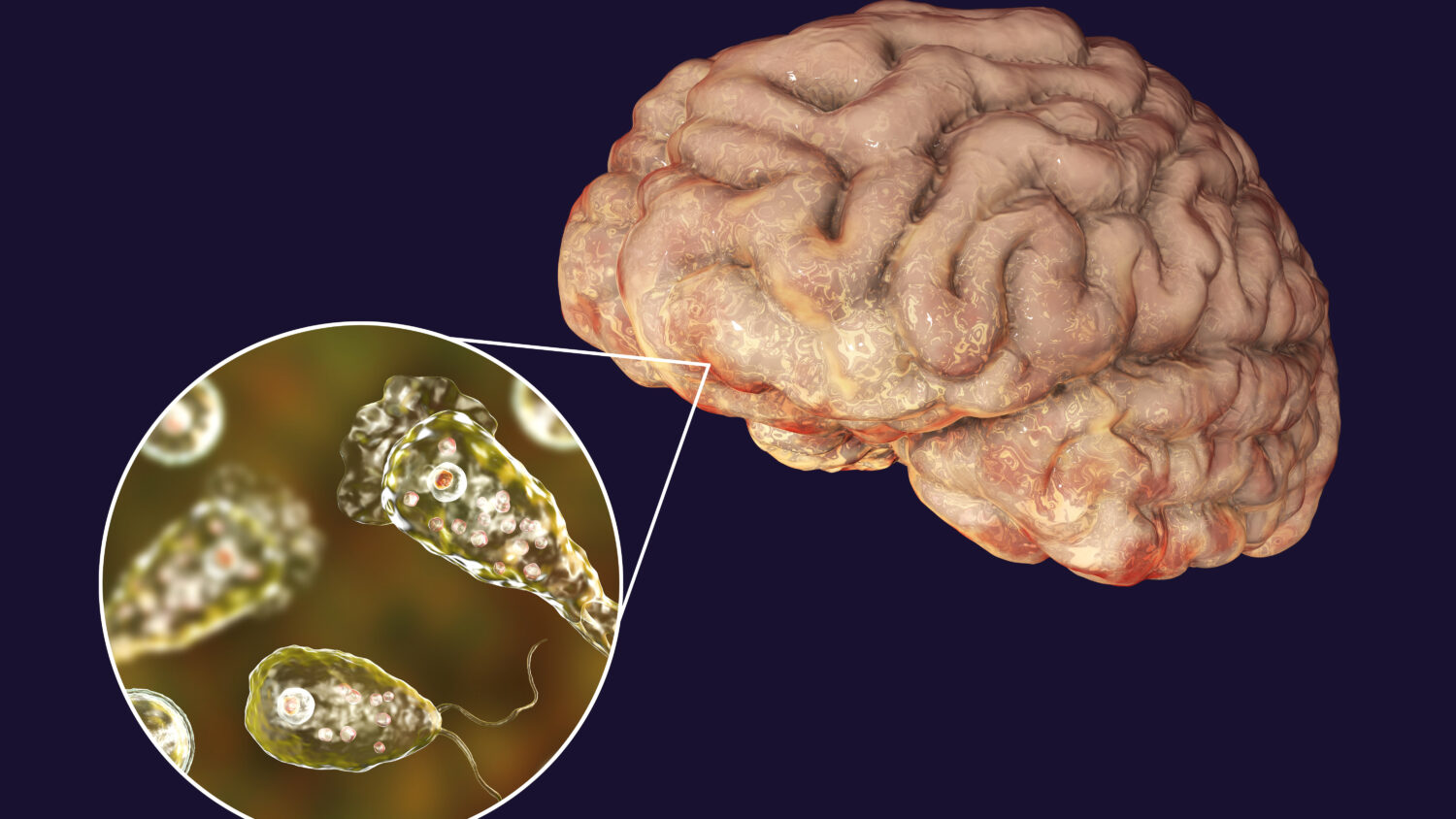 Karachi's reports first brain-eating amoeba, victim on ventilator