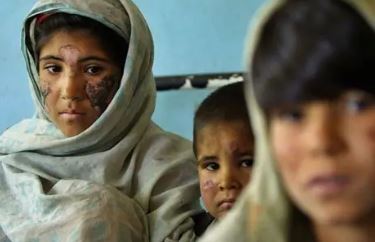 Leishmaniasis cases reach 255 in South Waziristan as health officials step up response