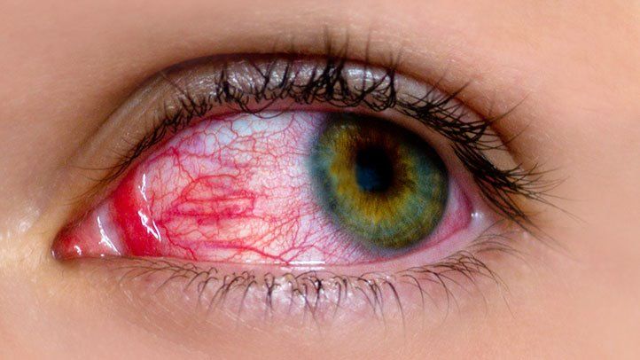 Blindness in the time of pinkeye