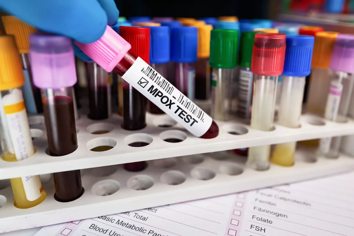 Mpox outbreak: Two more cases detected in KP, taking countrywide tally to 3