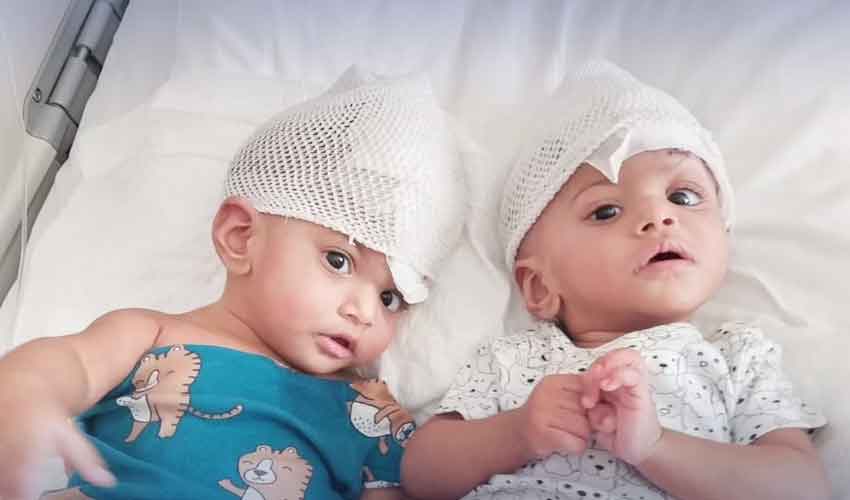 Pakistani conjoined twins successfully separated in Turkiye in 14-hour surgery