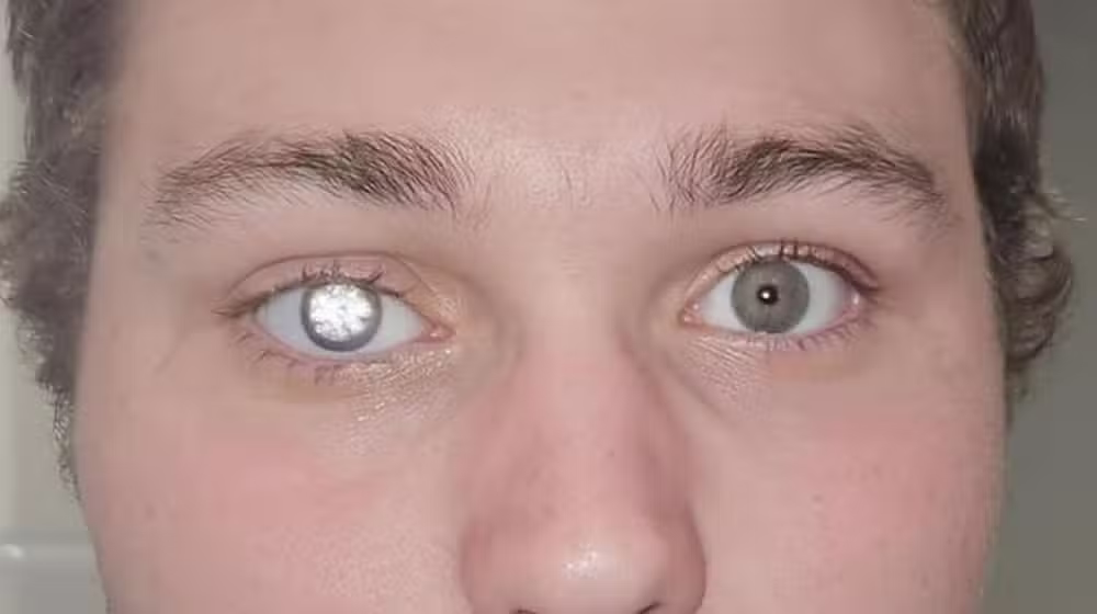 Man replaces his eye with a two-carat diamond