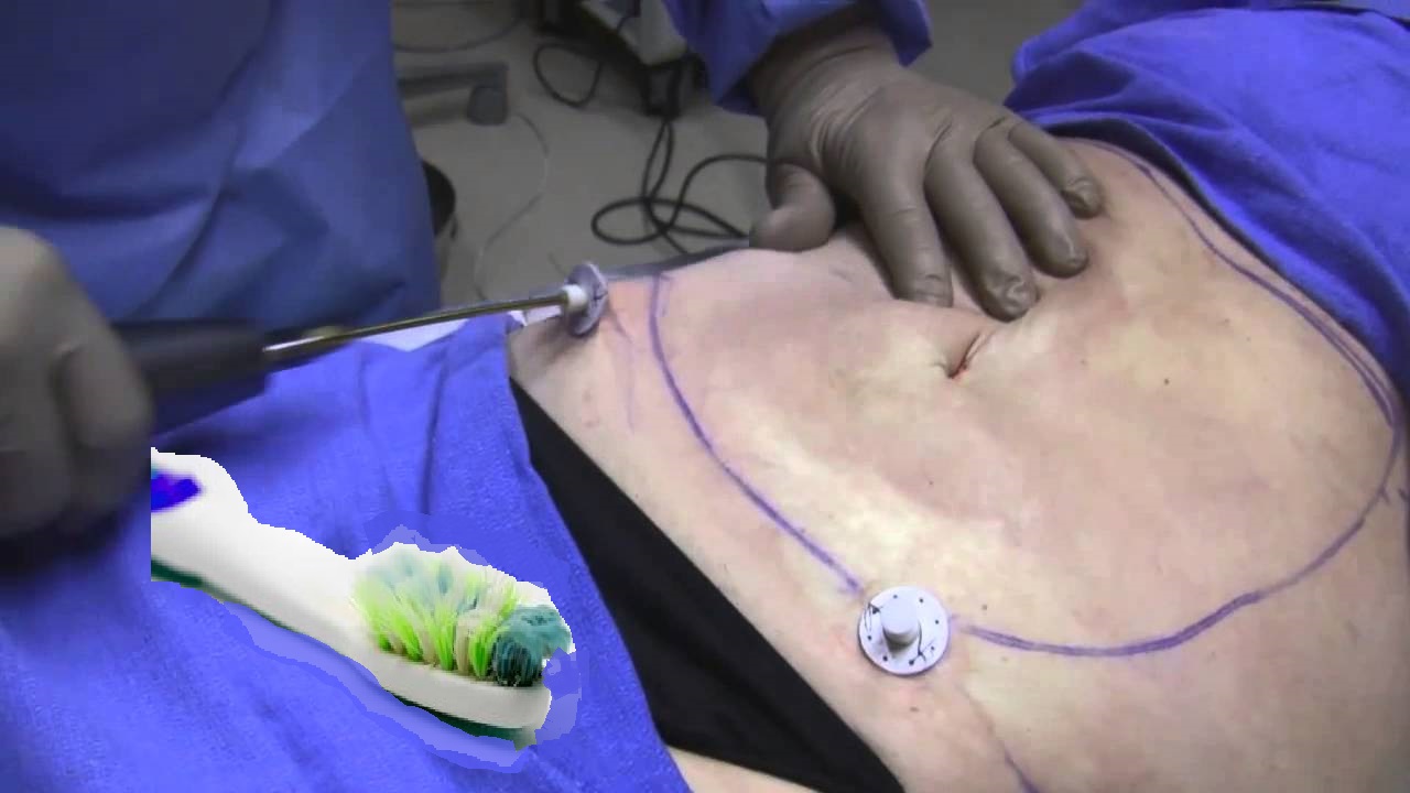 Toothbrush removed from man's stomach