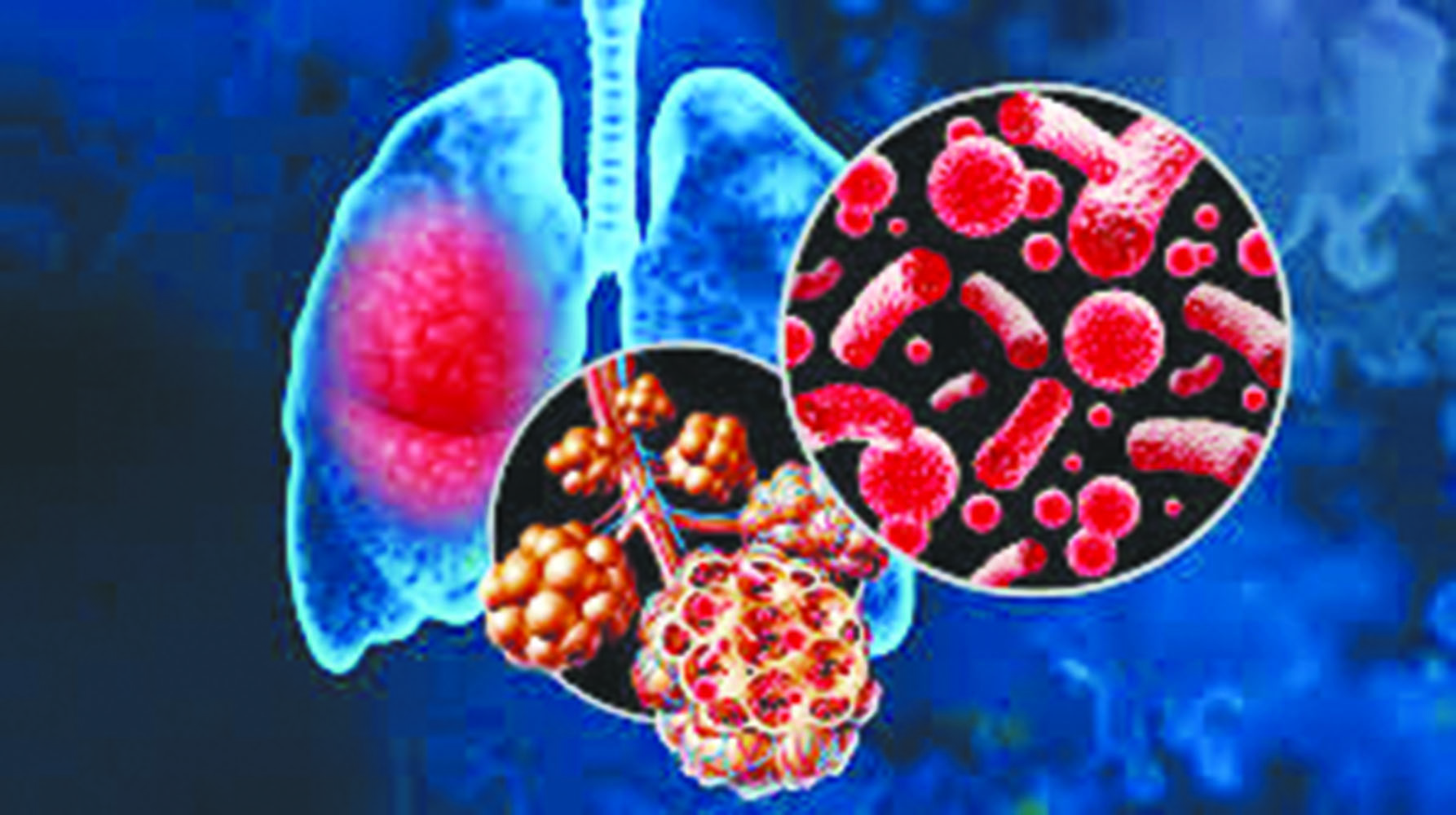 Pneumonia: A global silent killer we can prevent
