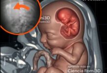 Rare surgery saves child with fetus in fetu condition in Rahim Yar Khan