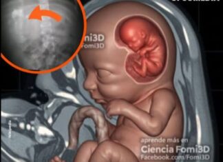 Rare surgery saves child with fetus in fetu condition in Rahim Yar Khan